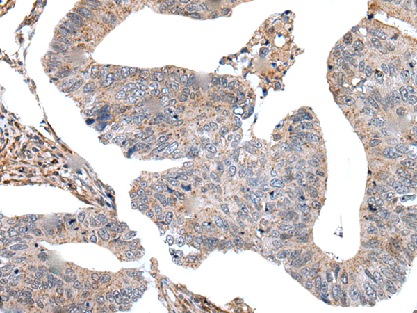 Immunohistochemistry of paraffin-embedded Human colorectal cancer tissue  using USP37 Polyclonal Antibody at dilution of 1:45(×200)