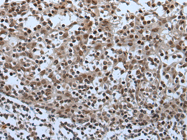 Immunohistochemistry of paraffin-embedded Human tonsil tissue  using CELF5 Polyclonal Antibody at dilution of 1:65(×200)