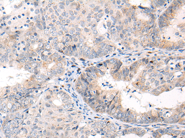 Immunohistochemistry of paraffin-embedded Human ovarian cancer tissue  using ANAPC15 Polyclonal Antibody at dilution of 1:70(×200)