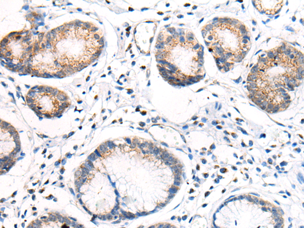 Immunohistochemistry of paraffin-embedded Human gastric cancer tissue  using ANAPC15 Polyclonal Antibody at dilution of 1:70(×200)