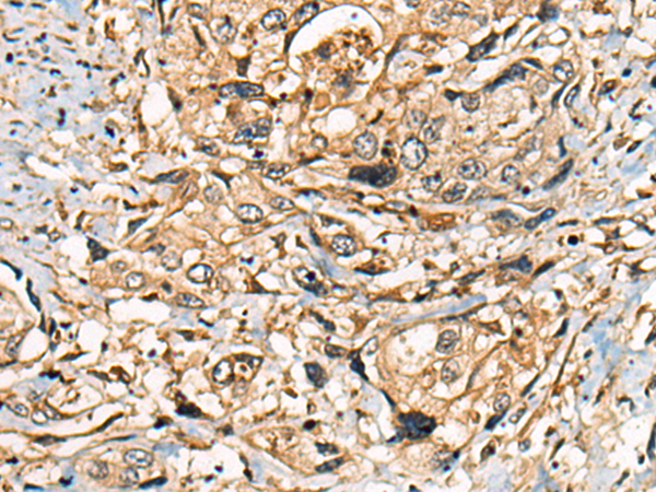 Immunohistochemistry of paraffin-embedded Human prost at e cancer tissue  using PIBF1 Polyclonal Antibody at dilution of 1:25(×200)