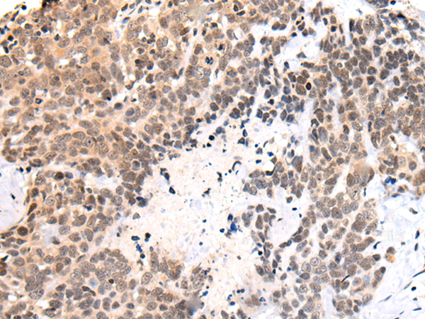 Immunohistochemistry of paraffin-embedded Human thyroid cancer tissue  using C14orf169 Polyclonal Antibody at dilution of 1:45(×200)