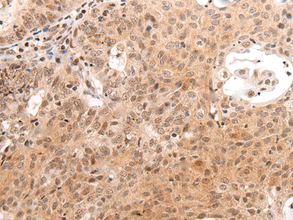 Immunohistochemistry of paraffin-embedded Human ovarian cancer tissue  using C14orf169 Polyclonal Antibody at dilution of 1:45(×200)