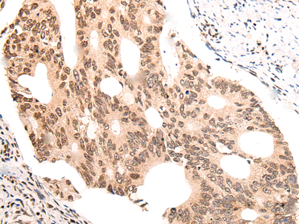 Immunohistochemistry of paraffin-embedded Human colorectal cancer tissue  using KNOP1 Polyclonal Antibody at dilution of 1:55(×200)