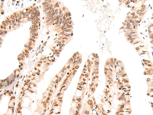 Immunohistochemistry of paraffin-embedded Human liver cancer tissue  using KNOP1 Polyclonal Antibody at dilution of 1:55(×200)
