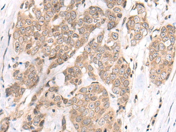 Immunohistochemistry of paraffin-embedded Human thyroid cancer tissue  using M1AP Polyclonal Antibody at dilution of 1:80(×200)