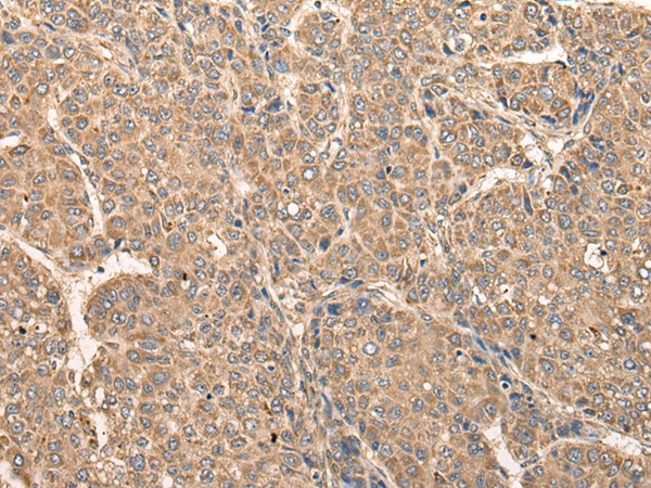 Immunohistochemistry of paraffin-embedded Human liver cancer tissue  using RCAN3 Polyclonal Antibody at dilution of 1:60(×200)