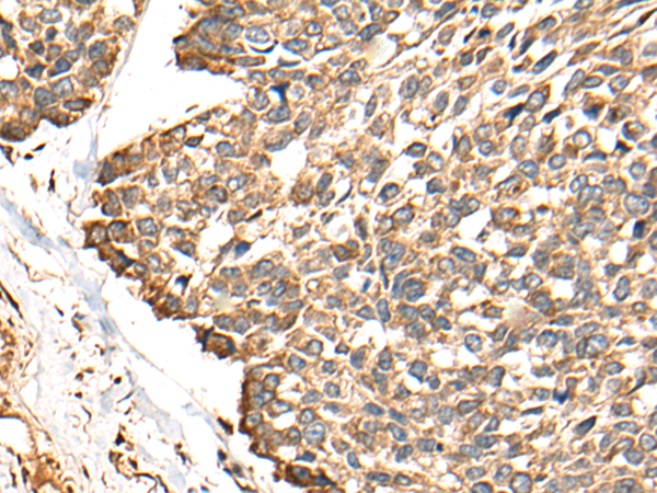 Immunohistochemistry of paraffin-embedded Human esophagus cancer tissue  using RCAN3 Polyclonal Antibody at dilution of 1:60(×200)