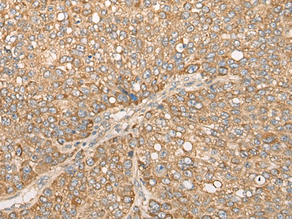 Immunohistochemistry of paraffin-embedded Human liver cancer tissue  using CAPN15 Polyclonal Antibody at dilution of 1:50(×200)