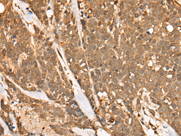 Immunohistochemistry of paraffin-embedded Human thyroid cancer tissue  using CAPN15 Polyclonal Antibody at dilution of 1:50(×200)