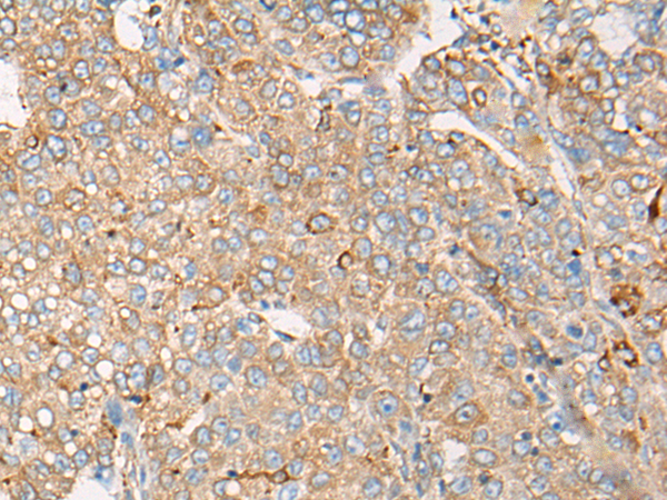 Immunohistochemistry of paraffin-embedded Human liver cancer tissue  using CAPN9 Polyclonal Antibody at dilution of 1:45(×200)