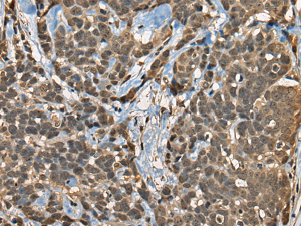 Immunohistochemistry of paraffin-embedded Human thyroid cancer tissue  using CIR1 Polyclonal Antibody at dilution of 1:40(×200)