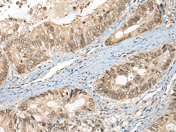 Immunohistochemistry of paraffin-embedded Human colorectal cancer tissue  using FUT4 Polyclonal Antibody at dilution of 1:40(×200)