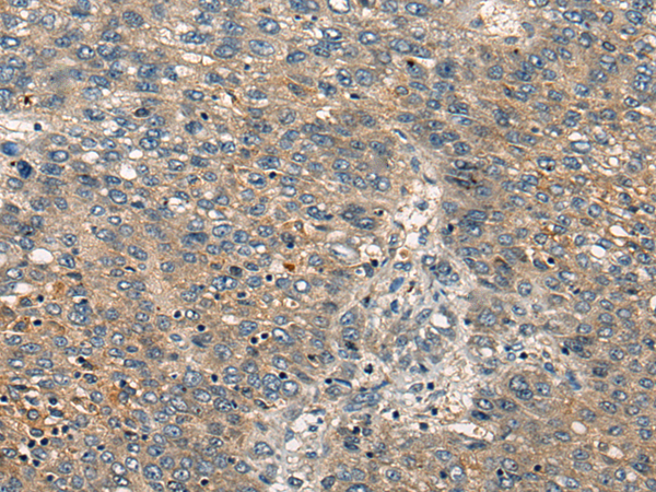 Immunohistochemistry of paraffin-embedded Human liver cancer tissue  using CDKL2 Polyclonal Antibody at dilution of 1:25(×200)