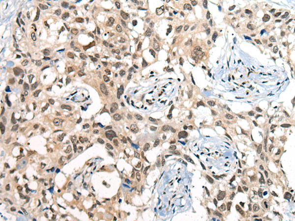 Immunohistochemistry of paraffin-embedded Human lung cancer tissue  using CDKL2 Polyclonal Antibody at dilution of 1:25(×200)