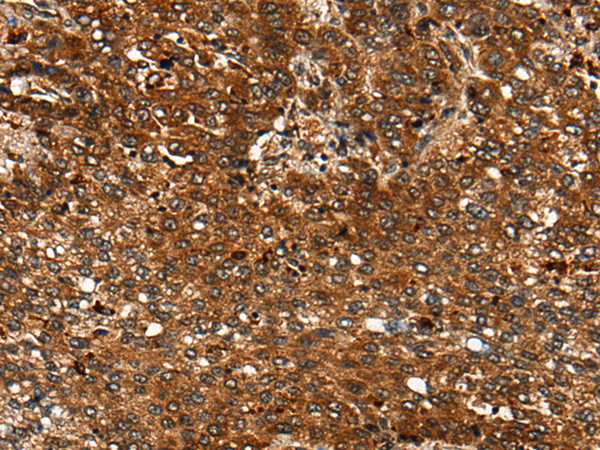 Immunohistochemistry of paraffin-embedded Human liver cancer tissue  using CDKL4 Polyclonal Antibody at dilution of 1:35(×200)