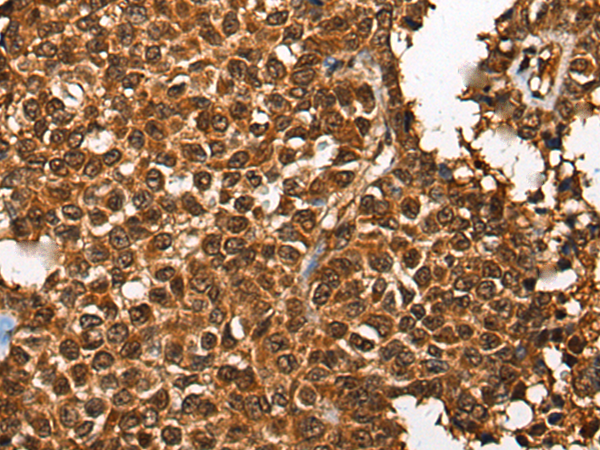 Immunohistochemistry of paraffin-embedded Human ovarian cancer tissue  using CDKL4 Polyclonal Antibody at dilution of 1:35(×200)