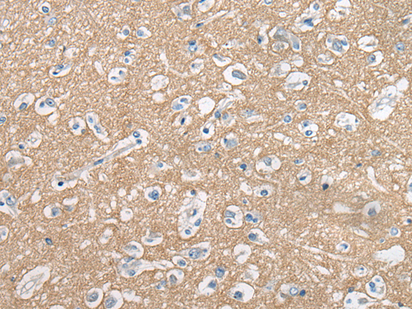 Immunohistochemistry of paraffin-embedded Human brain tissue  using CADM2 Polyclonal Antibody at dilution of 1:45(×200)