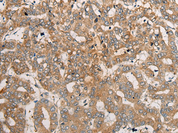 Immunohistochemistry of paraffin-embedded Human liver cancer tissue  using CEND1 Polyclonal Antibody at dilution of 1:50(×200)