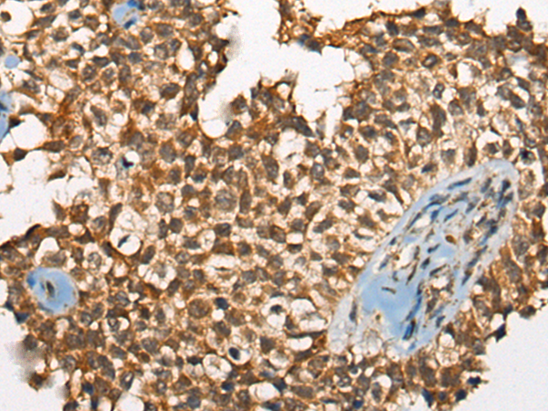 Immunohistochemistry of paraffin-embedded Human ovarian cancer tissue  using ODF2 Polyclonal Antibody at dilution of 1:110(×200)