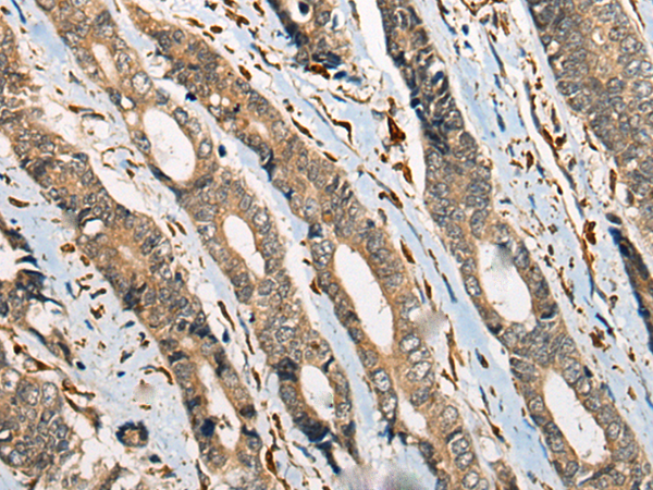 Immunohistochemistry of paraffin-embedded Human gastric cancer tissue  using ODF2 Polyclonal Antibody at dilution of 1:110(×200)