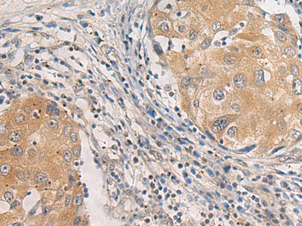 Immunohistochemistry of paraffin-embedded Human breast cancer tissue  using AGAP3 Polyclonal Antibody at dilution of 1:25(×200)