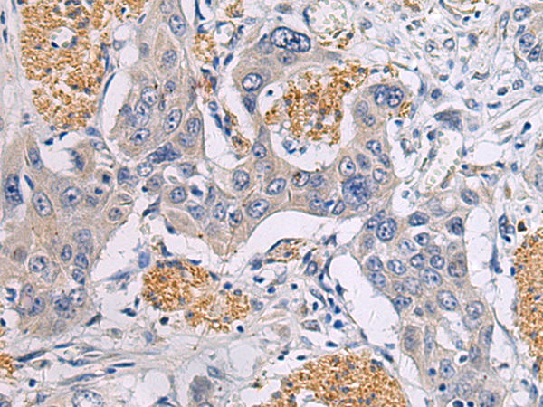 Immunohistochemistry of paraffin-embedded Human esophagus cancer tissue  using CHST3 Polyclonal Antibody at dilution of 1:30(×200)