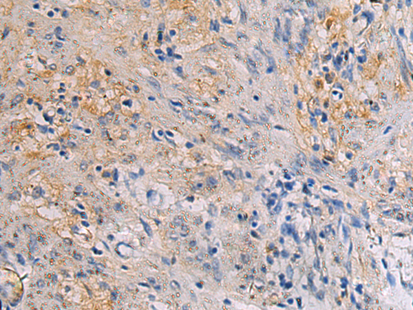 Immunohistochemistry of paraffin-embedded Human gastric cancer tissue  using CHST3 Polyclonal Antibody at dilution of 1:30(×200)