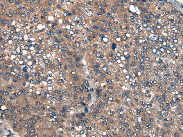 Immunohistochemistry of paraffin-embedded Human liver cancer tissue  using ICMT Polyclonal Antibody at dilution of 1:45(×200)