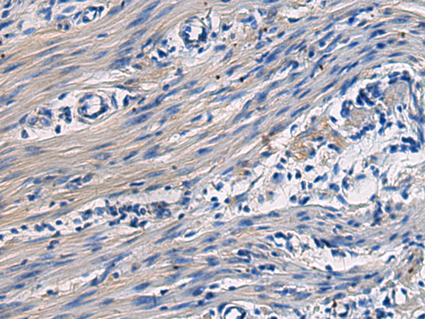 Immunohistochemistry of paraffin-embedded Human colorectal cancer tissue  using COL17A1 Polyclonal Antibody at dilution of 1:50(×200)