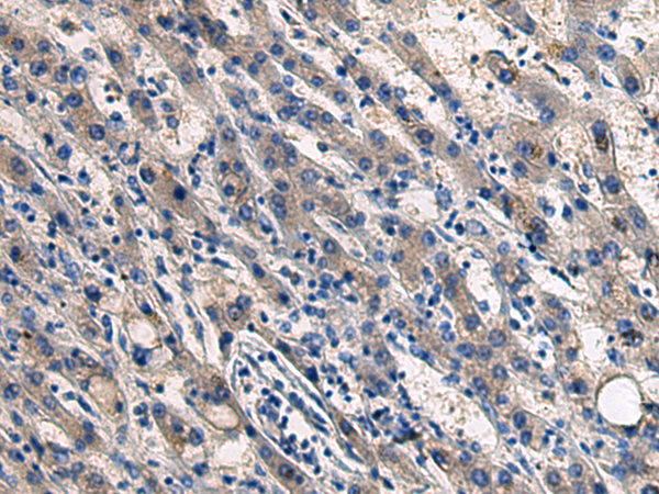 Immunohistochemistry of paraffin-embedded Human liver cancer tissue  using COL17A1 Polyclonal Antibody at dilution of 1:50(×200)