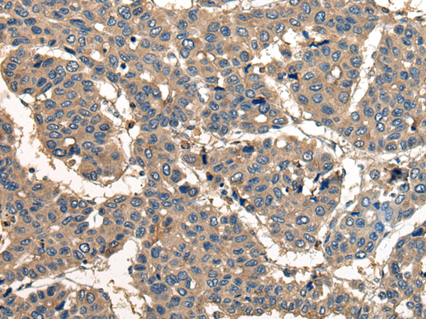 Immunohistochemistry of paraffin-embedded Human liver cancer tissue  using CORO1B Polyclonal Antibody at dilution of 1:40(×200)