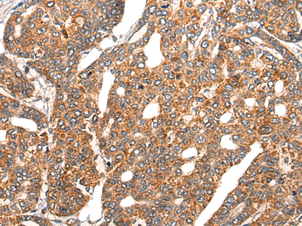 Immunohistochemistry of paraffin-embedded Human liver cancer tissue  using EPHA6 Polyclonal Antibody at dilution of 1:25(×200)