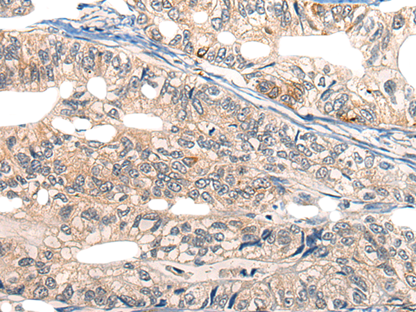 Immunohistochemistry of paraffin-embedded Human gastric cancer tissue  using EPHA6 Polyclonal Antibody at dilution of 1:25(×200)