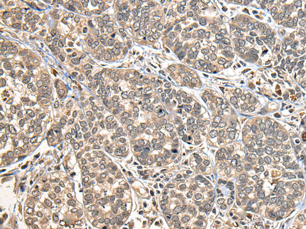 Immunohistochemistry of paraffin-embedded Human esophagus cancer tissue  using DGKI Polyclonal Antibody at dilution of 1:30(×200)