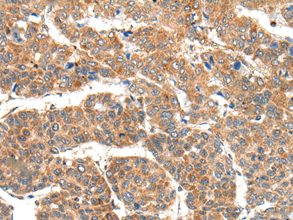 Immunohistochemistry of paraffin-embedded Human liver cancer tissue  using RPL14 Polyclonal Antibody at dilution of 1:30(×200)