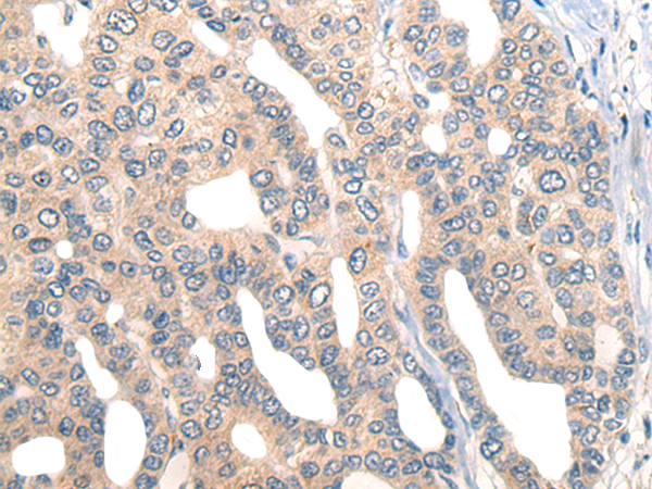 Immunohistochemistry of paraffin-embedded Human liver cancer tissue  using CORO2B Polyclonal Antibody at dilution of 1:50(×200)