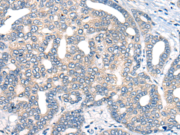 Immunohistochemistry of paraffin-embedded Human liver cancer tissue  using AURKA Polyclonal Antibody at dilution of 1:40(×200)
