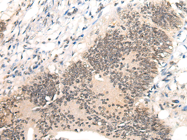 Immunohistochemistry of paraffin-embedded Human colorectal cancer tissue  using AURKA Polyclonal Antibody at dilution of 1:40(×200)