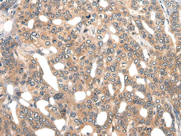 Immunohistochemistry of paraffin-embedded Human liver cancer tissue  using GPR55 Polyclonal Antibody at dilution of 1:40(×200)