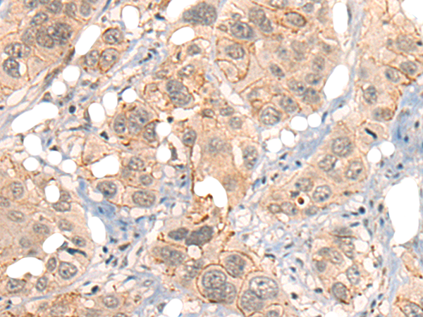 Immunohistochemistry of paraffin-embedded Human esophagus cancer tissue  using GPR55 Polyclonal Antibody at dilution of 1:40(×200)