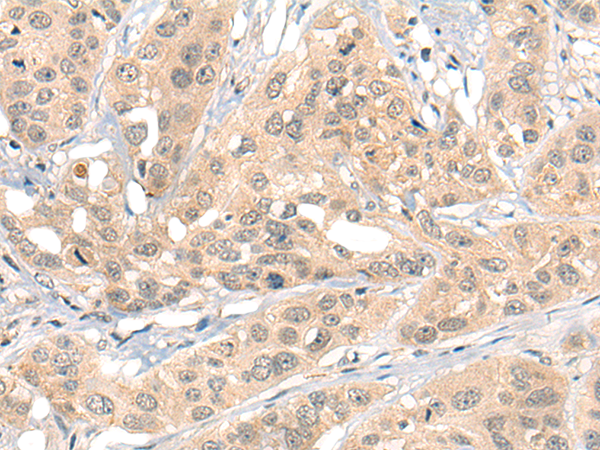 Immunohistochemistry of paraffin-embedded Human esophagus cancer tissue  using HIPK2 Polyclonal Antibody at dilution of 1:40(×200)