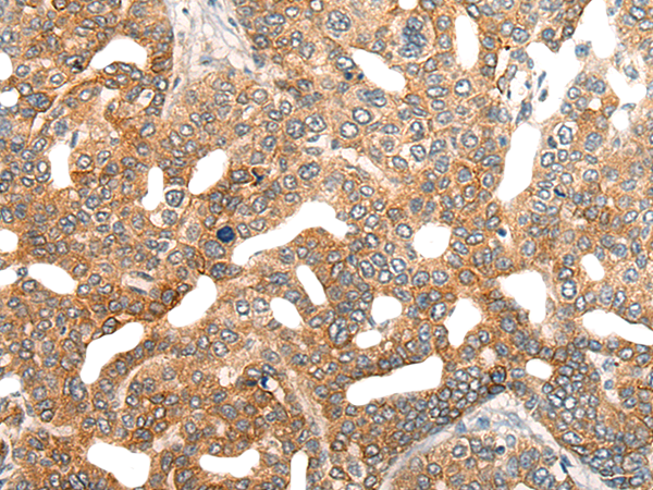 Immunohistochemistry of paraffin-embedded Human liver cancer tissue  using HIPK2 Polyclonal Antibody at dilution of 1:40(×200)