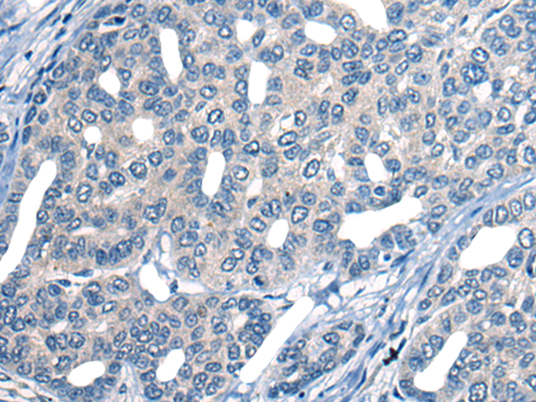 Immunohistochemistry of paraffin-embedded Human liver cancer tissue  using MARK2 Polyclonal Antibody at dilution of 1:25(×200)