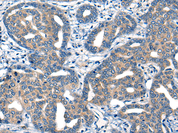 Immunohistochemistry of paraffin-embedded Human liver cancer tissue  using MIIP Polyclonal Antibody at dilution of 1:45(×200)