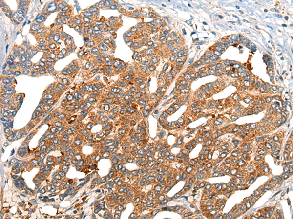 Immunohistochemistry of paraffin-embedded Human liver cancer tissue  using NOG Polyclonal Antibody at dilution of 1:40(×200)