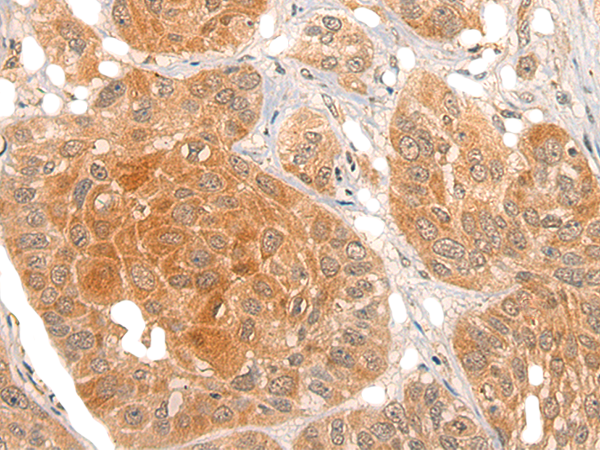 Immunohistochemistry of paraffin-embedded Human esophagus cancer tissue  using NOG Polyclonal Antibody at dilution of 1:40(×200)