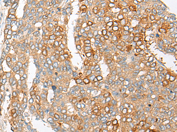 Immunohistochemistry of paraffin-embedded Human liver cancer tissue  using PCDHGB5 Polyclonal Antibody at dilution of 1:35(×200)