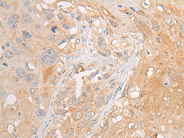 Immunohistochemistry of paraffin-embedded Human esophagus cancer tissue  using PCDHGB5 Polyclonal Antibody at dilution of 1:35(×200)