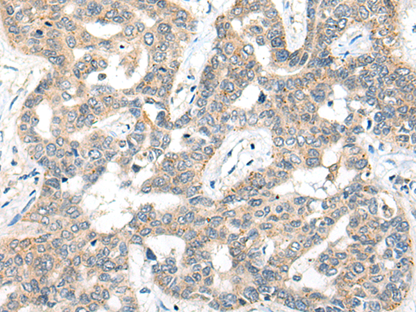 Immunohistochemistry of paraffin-embedded Human liver cancer tissue  using SNX6 Polyclonal Antibody at dilution of 1:50(×200)